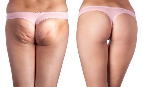 Die Cellulite-Entfernung ist ein Verfahren, das darauf abzielt, das Erscheinungsbild von Cellulite zu reduzieren und die Hautstruktur zu verbessern.