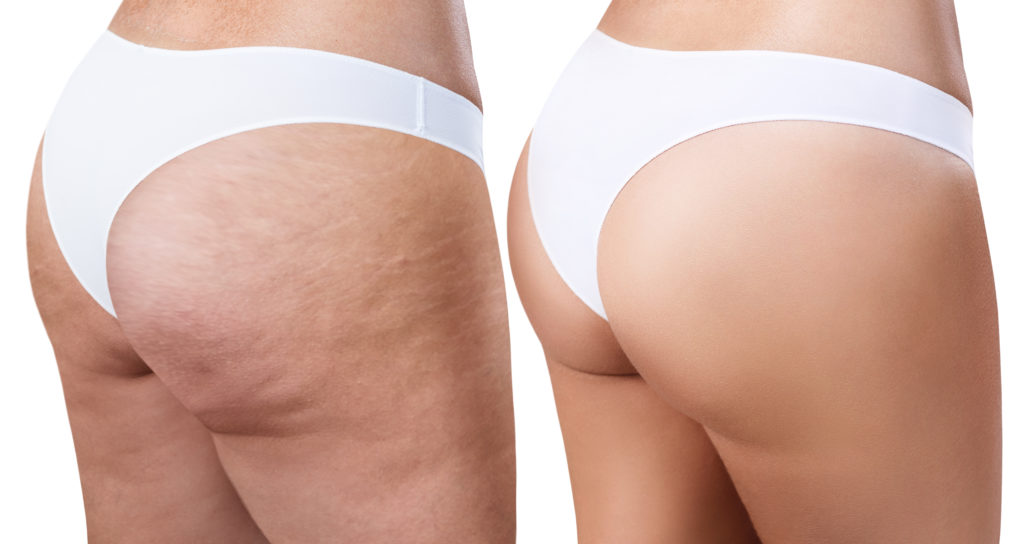Die Cellulite-Entfernung ist ein Verfahren, das darauf abzielt, das Erscheinungsbild von Cellulite zu reduzieren und die Hautstruktur zu verbessern.