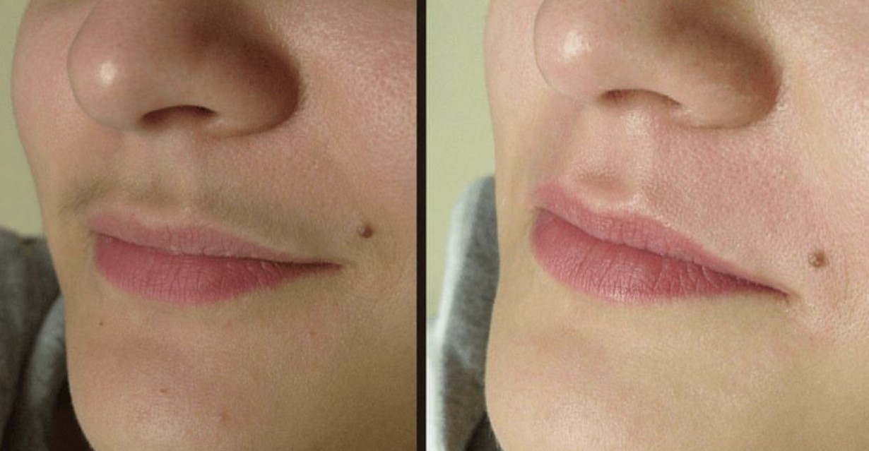 Wie funktioniert die Laser Haarentfernung im Gesicht