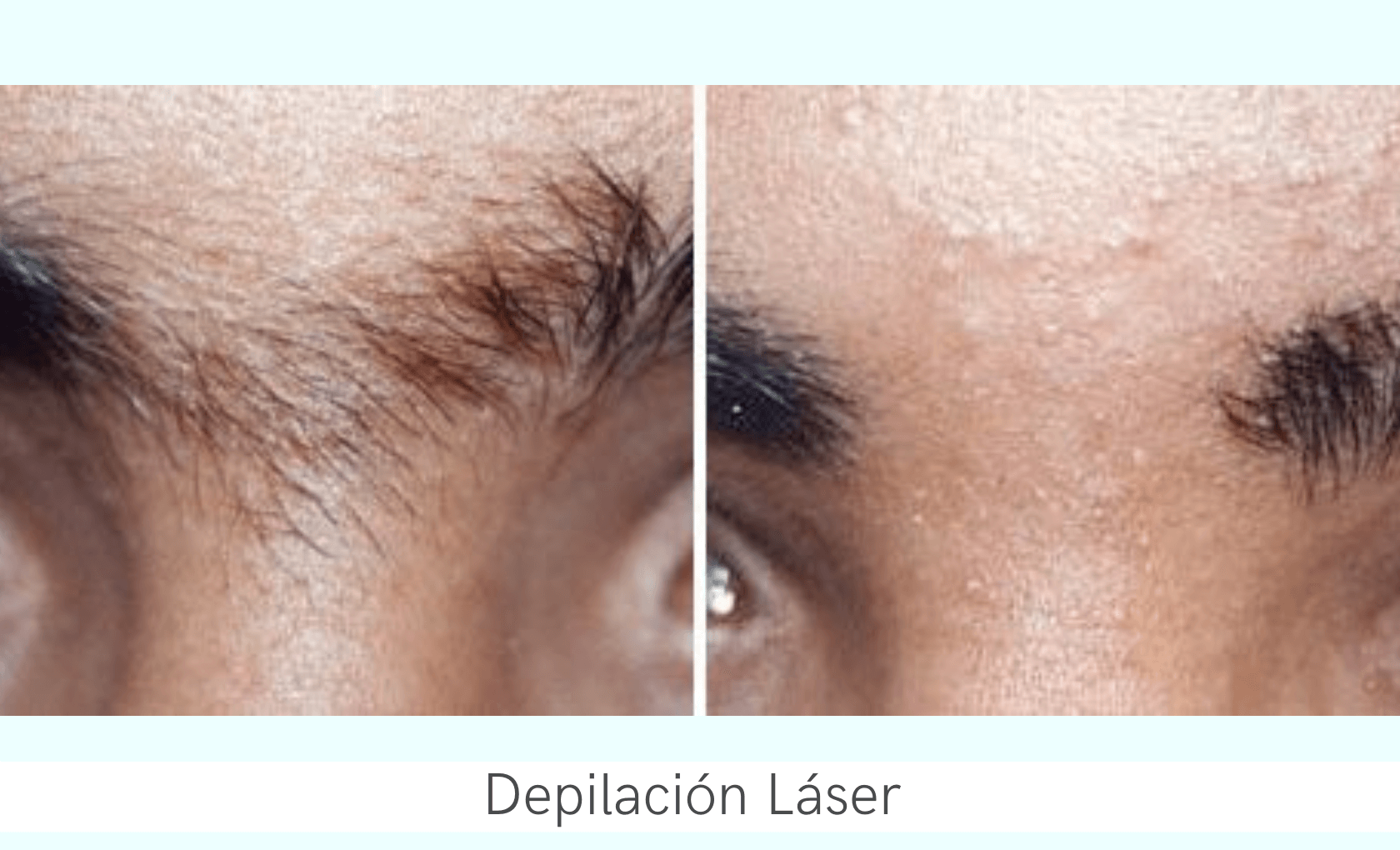 Laserhaarentfernung  7.png