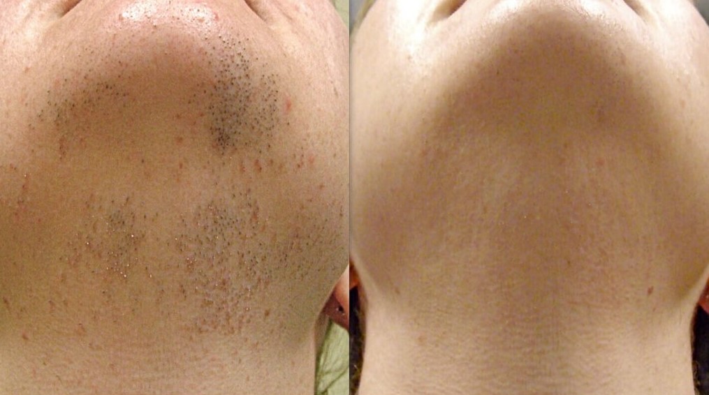 Gezielte Bereiche für die Laser Haarentfernung