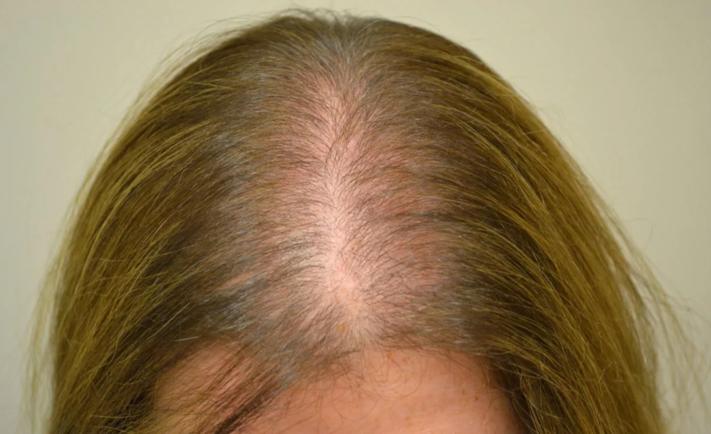 Haarausfall bei Frauen Haarausfall bei Frauen