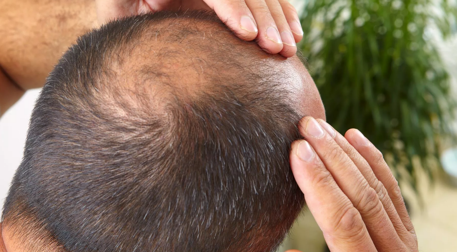 Männlich bedingter Haarausfall Männlich bedingter Haarausfall