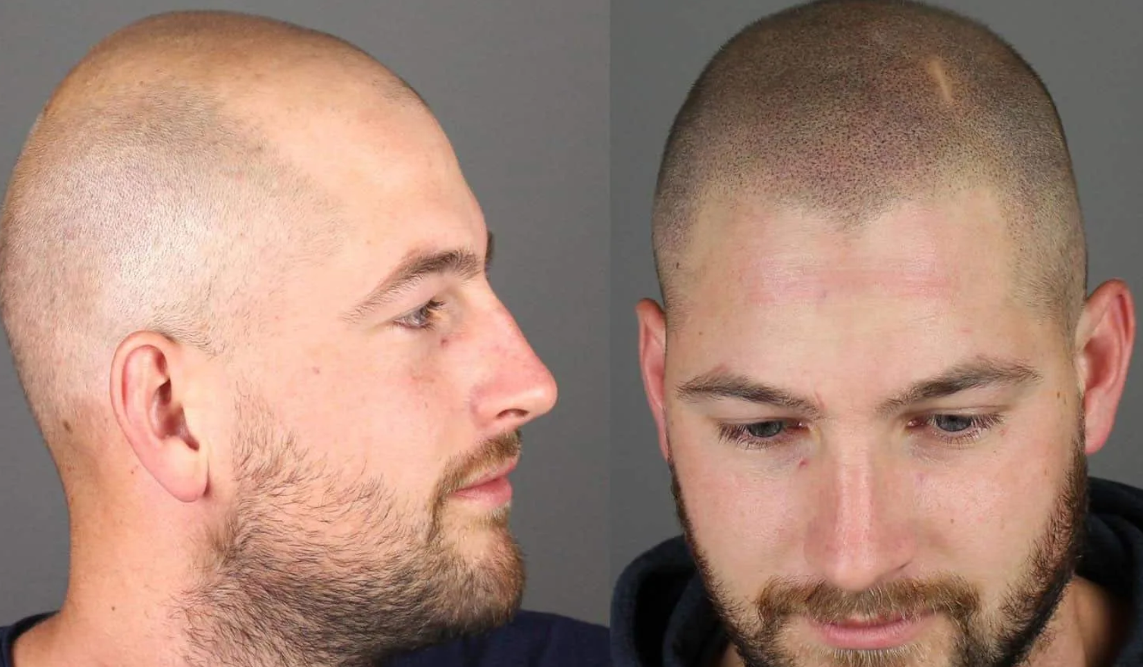 Was ist Kopfhaut-Mikropigmentierung Was ist Kopfhaut-Mikropigmentierung