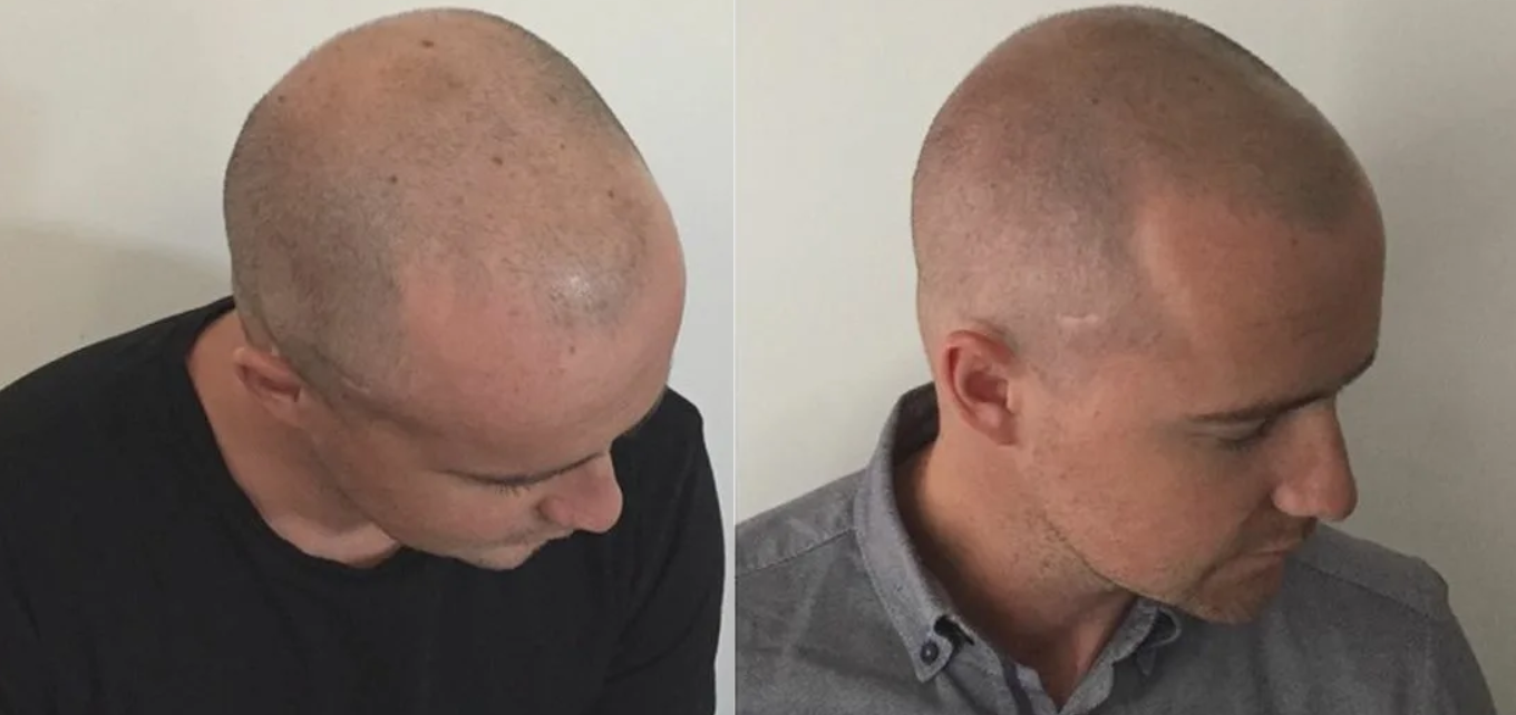 Wie wirkt die Mikropigmentierung der Kopfhaut gegen Haarausfall? Wie wirkt die Mikropigmentierung der Kopfhaut gegen Haarausfall?