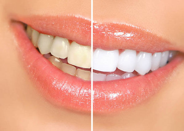 Kosmetisches Zahnbleaching ist ein Verfahren, das darauf abzielt, die Zähne aufzuhellen und ein strahlenderes Lächeln zu erzielen.
