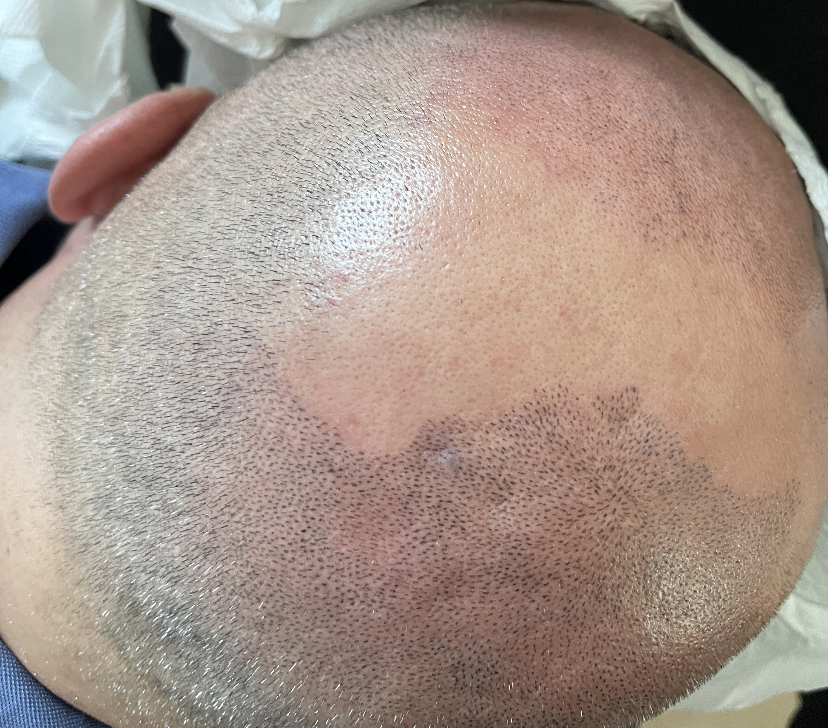Haarpigmentierung Hinterkopf Mann im Stirn- und Kronen Bereich