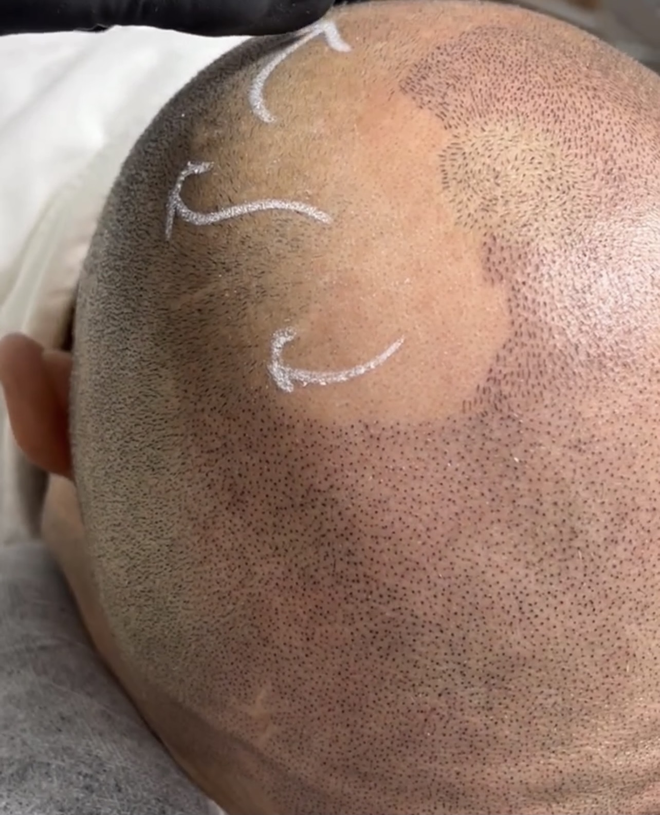 Haarpigmentierung Hinterkopf Mann bei Narben und im Kronen Bereich