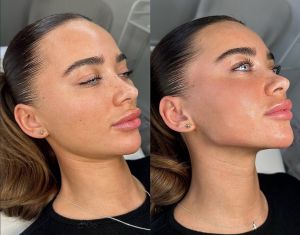Brünette Frau nach Jawline Eingriff